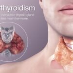 Hyperthyroidism