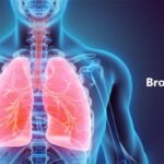 bronchitis