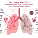 copd