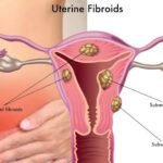 uterine-fibroids